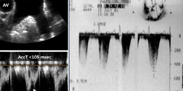 Potential Use of Systolic Pulmonary Artery Pressure/Pulmonary Artery Acceleration Time Ratio in Severe Functional Tricuspid Regurgitation with Pulmonary Hypertension.