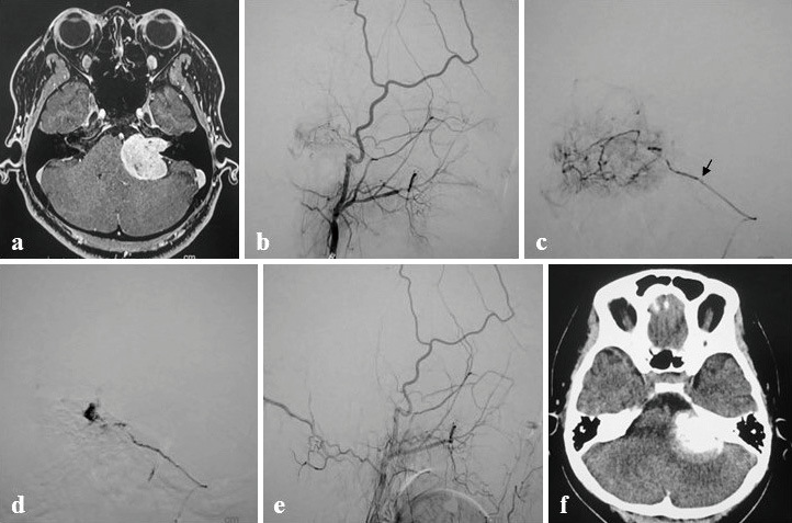 Embosphere Size Selection and Dilution Rate in Preoperative Tumor Embolization of the External Carotid Artery System Using a Small-diameter Catheter.