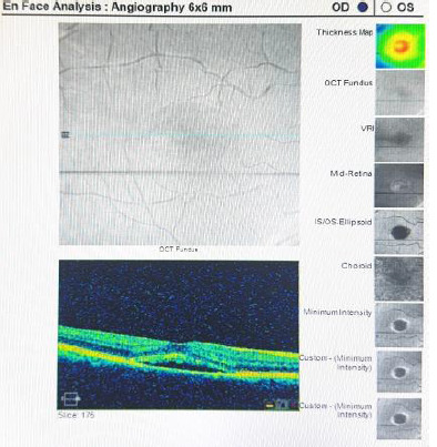 Uncommon Therapeutic Approaches for Patients with Recurrent Central Serous Chorioretinopathy: case report and literature review.