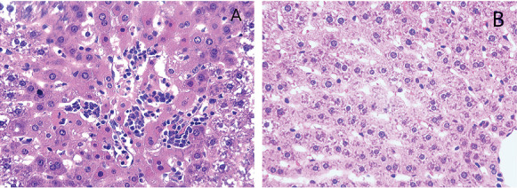 The Role of Key Molecules of Pyroptosis in Liver Damage of Rats With Exertional Heat Stroke.