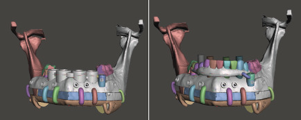 Fully Digital Workflow for Immediate Prosthetic Implant on Microsurgery Fibula Flap for Mandibular Reconstruction.