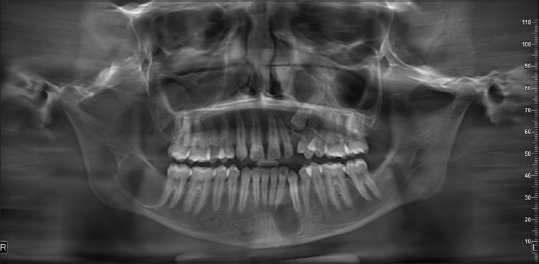 Navigating Beyond a Cyst: The Intricate World of Gorlin Goltz Syndrome - A Case Report.