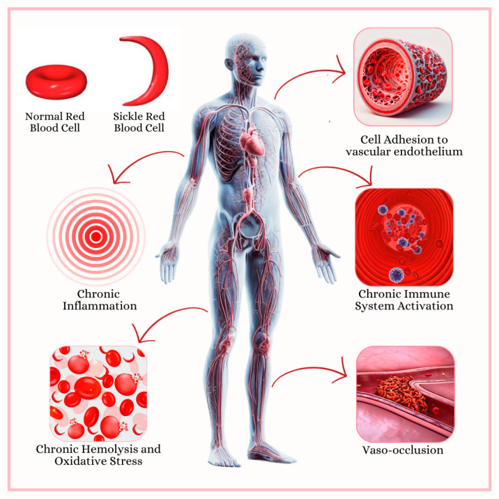 Sickle Cell Anemia and Inflammation: A Review of Stones and Landmarks Paving the Road in the Last 25 Years.