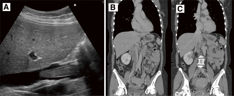 Intravenous Leiomyomatosis of the Uterus Extending to the Right Atrium: A Case Report.