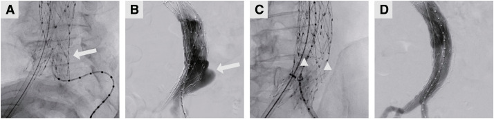 Successful Treatment of Type 3b Endoleak after AFX Using TREO.