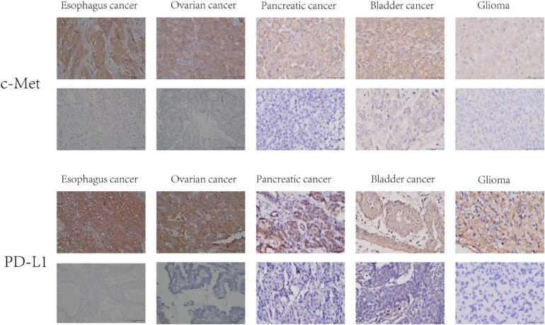 Bispecific c-Met/PD-1 CAR-T Cells Have Enhanced Therapeutic Effects on Solid Tumor.