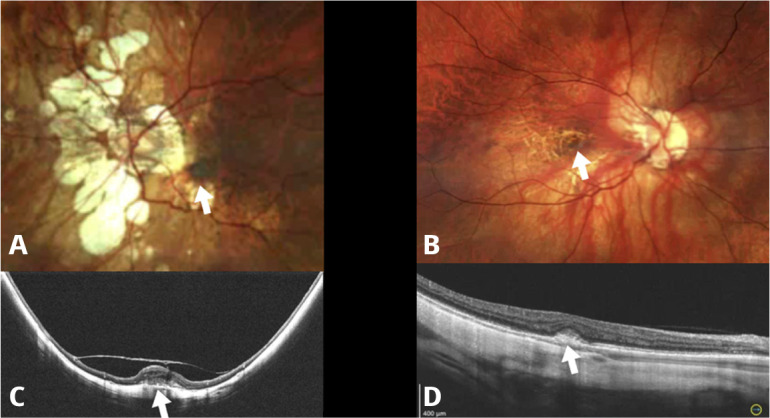 Management of myopic traction maculopathy.