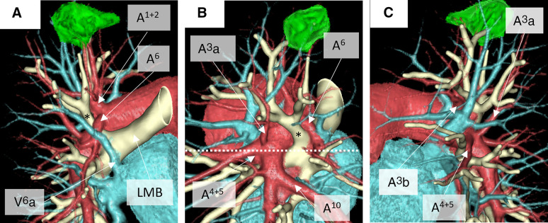 Robotic Segmentectomy in a Patient with a Displaced Left Upper Division Bronchus and Fused Fissure.