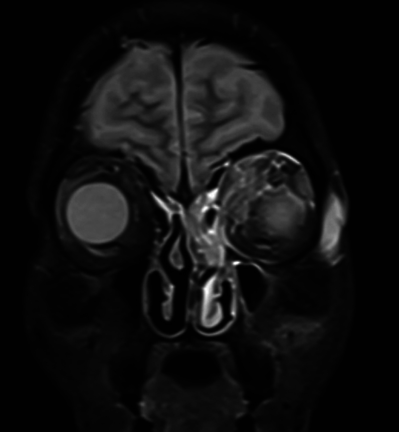 Endoscopic Orbital Clearance/Debridement: A Potential Substitute for Orbital Exenteration in Rhino-orbital Mucormycosis.
