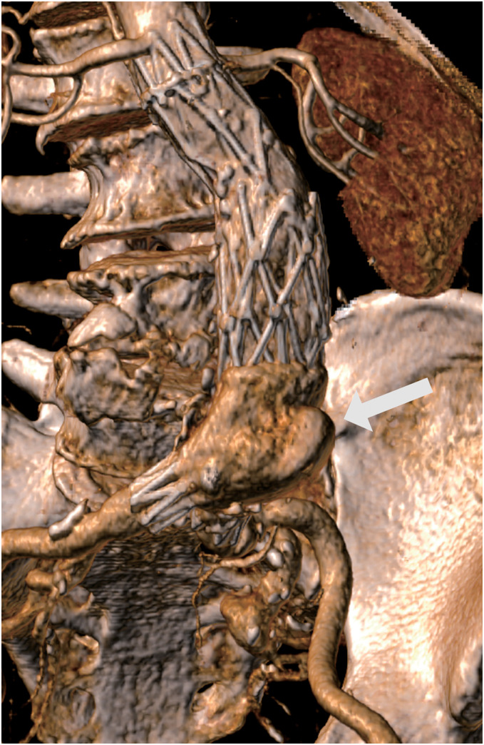 Successful Treatment of Type 3b Endoleak after AFX Using TREO.
