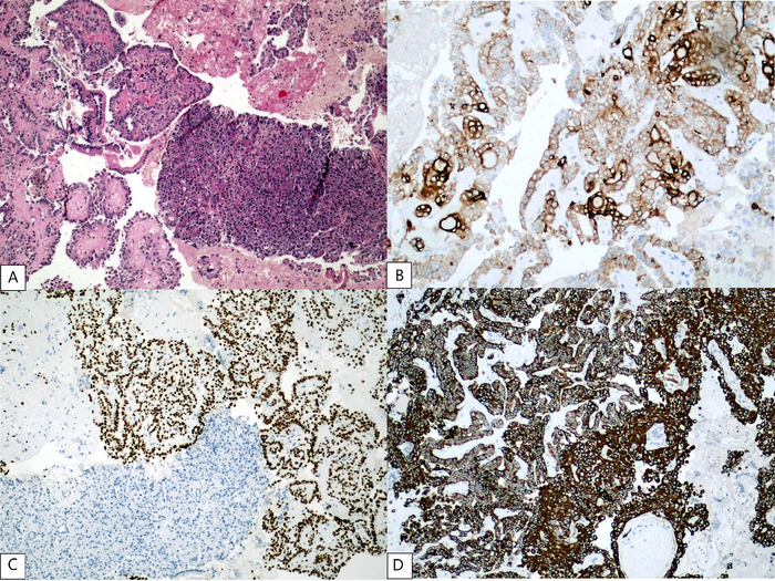 Late Pancreatic Metastasis From Papillary Thyroid Carcinoma Diagnosed by Endoscopic Ultrasound-Guided Tissue Acquisition.