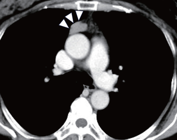 Thymoma without Myasthenia Gravis Showing Size Fluctuation in Parallel to Alopecia Areata Activity: A Case Report.