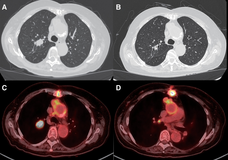 Surgical Management of Destructive Thyroiditis Triggered by Neoadjuvant Immune Checkpoint Inhibitor Therapy in Locally Advanced Non-Small Cell Lung Cancer: A Case Report.