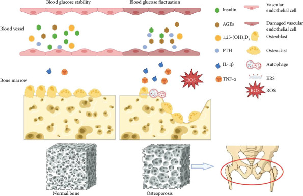Correlation Between Blood Glucose Fluctuations and Osteoporosis in Type 2 Diabetes Mellitus.