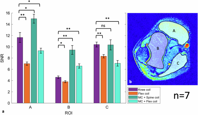 Flexible and wireless metasurface coils for knee and elbow MRI.