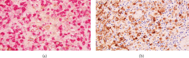 A Case of Atraumatic Splenic Rupture Due to T-Cell/Histiocyte-Rich Large B-Cell Lymphoma and a Potential Role for Massive Transfusion Protocol.