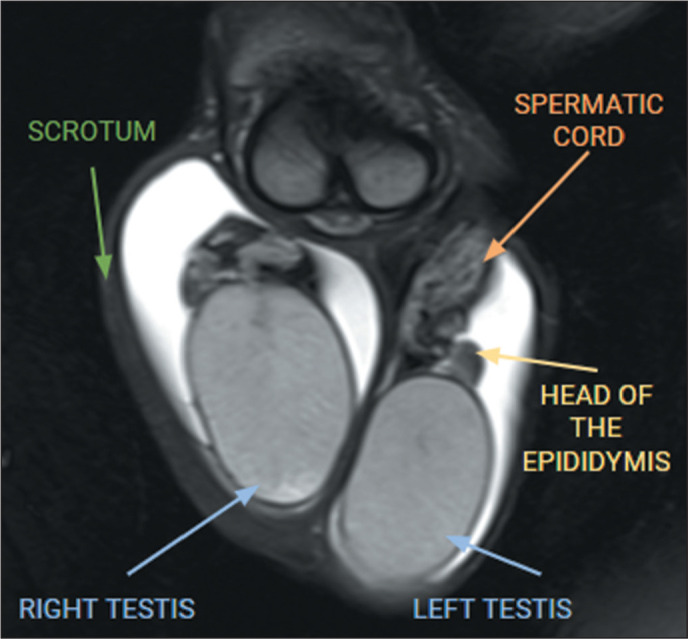 Non-neoplastic and neoplastic scrotal pathologies on magnetic resonance imaging: a pictorial essay.