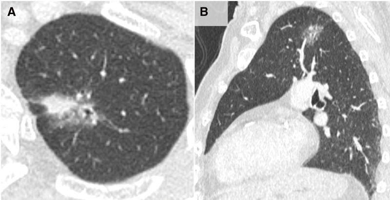 Robotic Segmentectomy in a Patient with a Displaced Left Upper Division Bronchus and Fused Fissure.