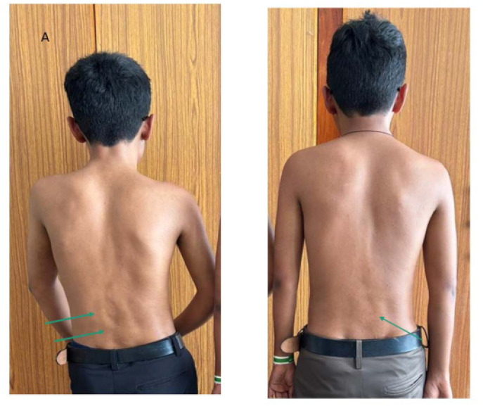 All Restricted Spines are not Spondyloarthritis: Fibrodysplasia Ossificans Progressiva (FOP) in Monozygotic Twins presenting to Rheumatology Clinic.