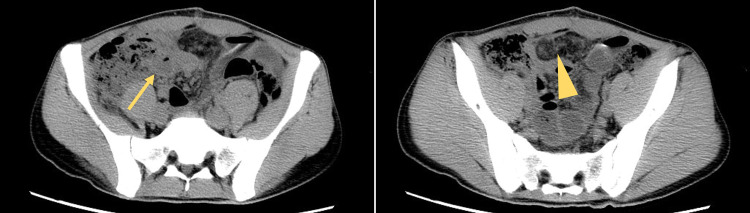 A Case of Appendicitis Due to Burkitt Lymphoma Masking the Systemic Symptoms of Rapidly Progressing Burkitt Lymphoma.