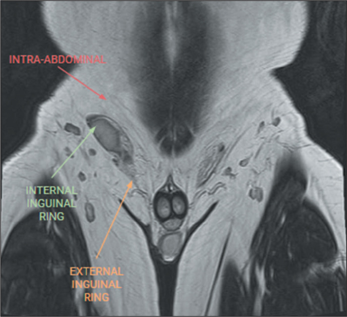 Non-neoplastic and neoplastic scrotal pathologies on magnetic resonance imaging: a pictorial essay.