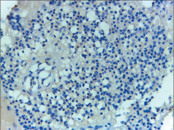 Role of HEG1 and Claudin-4 Immunohistochemistry in the Differential Diagnosis of Lung Adenocarcinoma from Malignant Mesothelioma in Pleural Effusion Cytology.