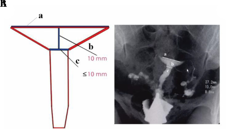 Comparison of <i>In Vitro</i> Fertilization Outcomes between Normal and T-Shaped Uteri, Diagnosed by Hysterosalpingography in Women with infertility: A Retrospective Cohort Study.