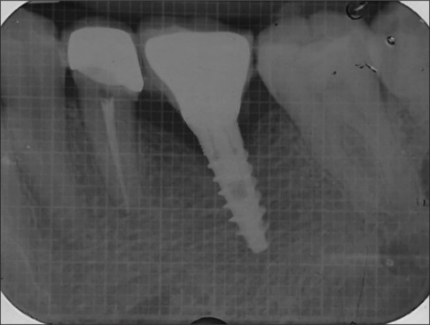 Survival of narrow diameter implants in supporting single crowns in the molar region of the jaw.