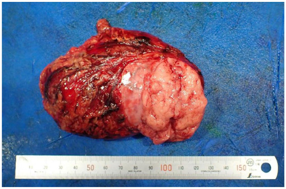 Atypical Presentation of Giant Pheochromocytoma Managed With Minimally Invasive Surgery.
