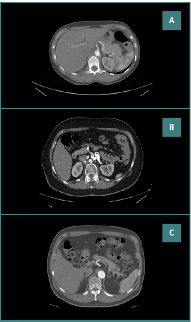 The celiac ganglia and trunk: an assessment of anatomical variants and their clinical relevance.