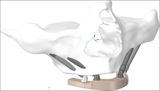 Biomechanical Behaviour of Quad Zygoma Technique Using a Smooth Body Zygomatic Implant and Angled Abutments - An <i>In Vitro</i> Study.