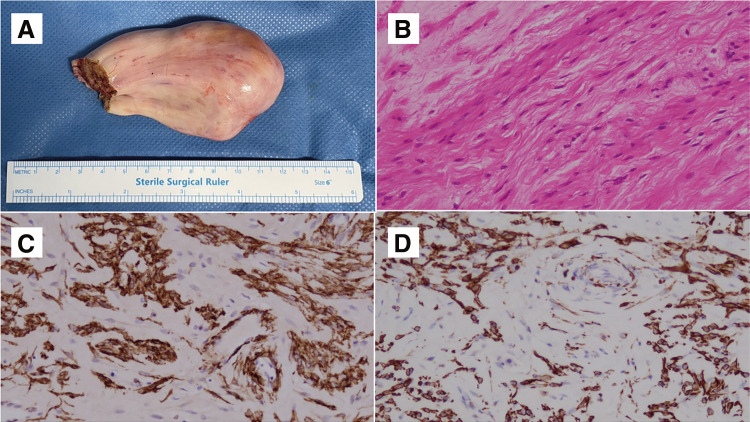 Intravenous Leiomyomatosis of the Uterus Extending to the Right Atrium: A Case Report.