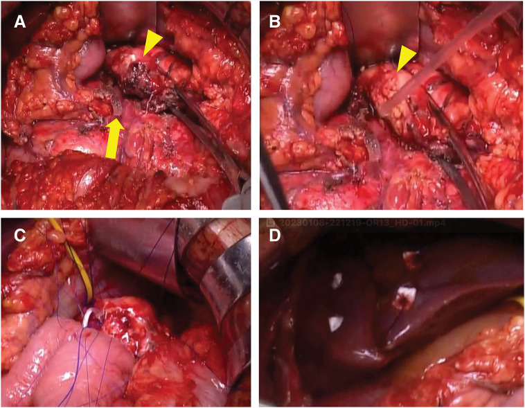 Middle Pancreatectomy for Traumatic Main Pancreatic Duct Injury with Delayed Presentation: Two Case Series.