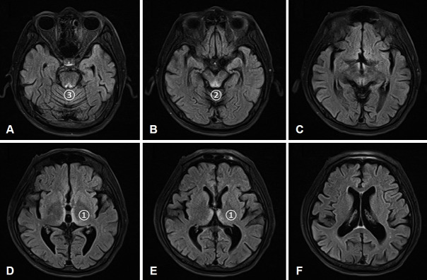 A Case of Bilateral Sudden Deafness Caused by Wernicke Encephalopathy.