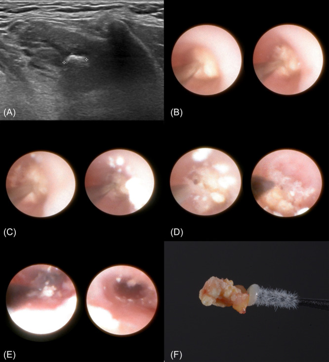 Clinical Efficacy and Outcomes of Electro-Pneumatic Intracorporeal Lithotripsy in the Management of Sialolithiasis.