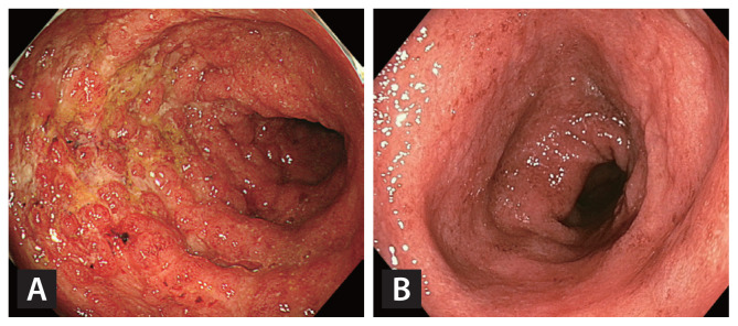 Incidence and risk factors of immune checkpoint inhibitor-induced colitis in Korean patients with cancer.