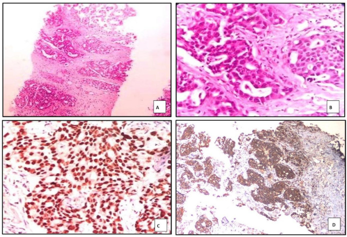 Evaluation of TTF-1, Napsin A, p40, and p63 in the Subtyping of Non-Small Cell Lung Carcinoma: A Cross-Sectional Study from India.