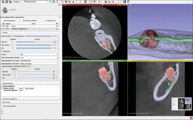 Three-dimensional reconstruction of cone beam CT scan in the planning of the surgery of mandibular impacted third molars.