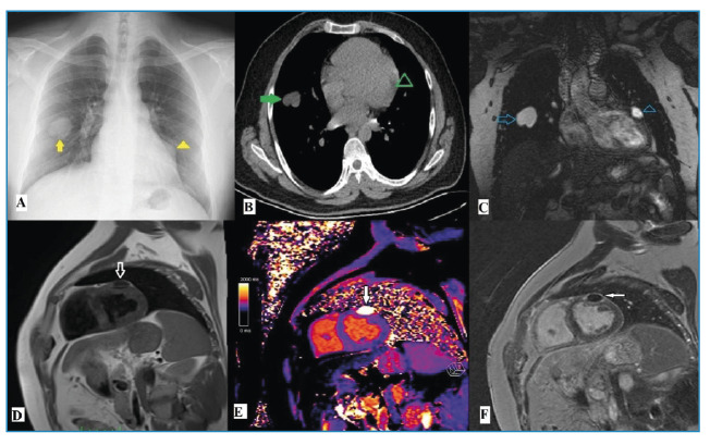 Incidentally Detected Cardiac Hydatid Cyst: A Rare Case Report.