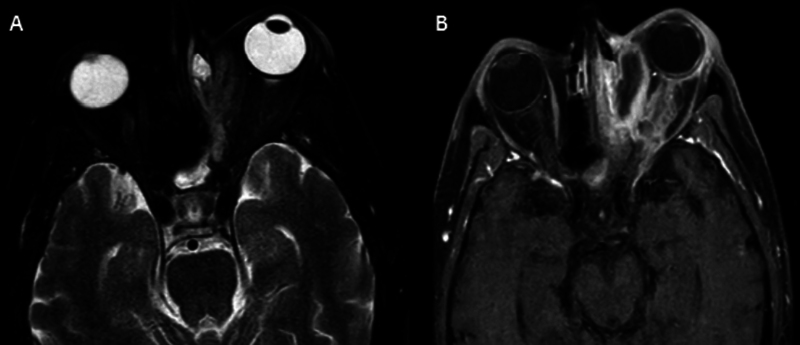Endoscopic Orbital Clearance/Debridement: A Potential Substitute for Orbital Exenteration in Rhino-orbital Mucormycosis.