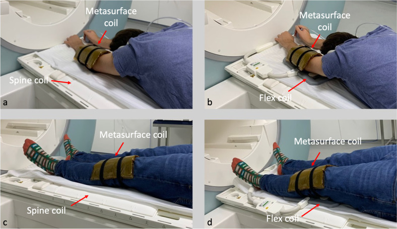 Flexible and wireless metasurface coils for knee and elbow MRI.