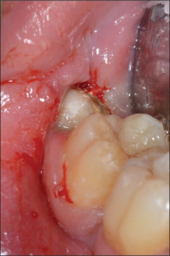 Three-dimensional reconstruction of cone beam CT scan in the planning of the surgery of mandibular impacted third molars.
