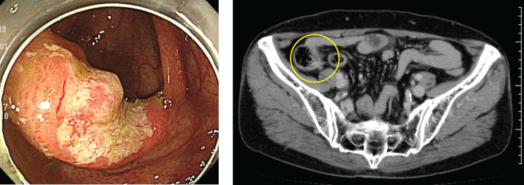 Rare Case of Additional Ileocecal Resection for Ascending Colon Cancer with R1 Resection due to Advanced Perineural Invasion.