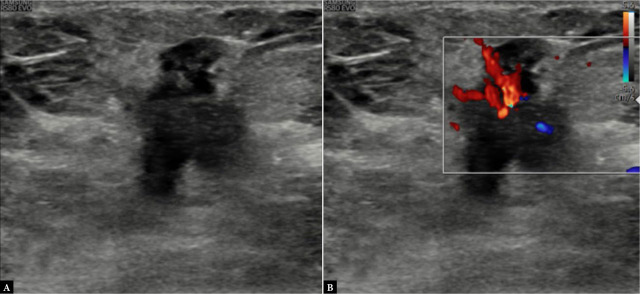Ultrasonography: an aid in molecular subtyping of breast carcinoma.