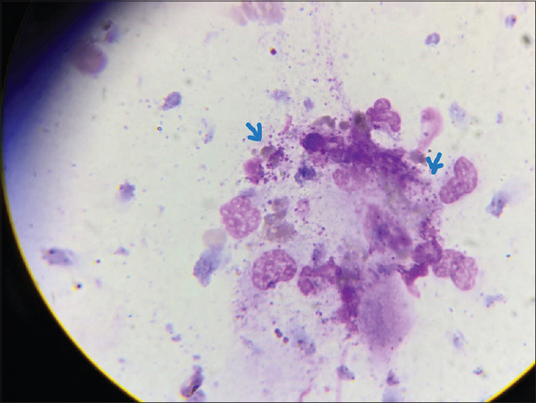 Whether reactivation of granuloma inguinale can be a possibility in a person living with HIV?