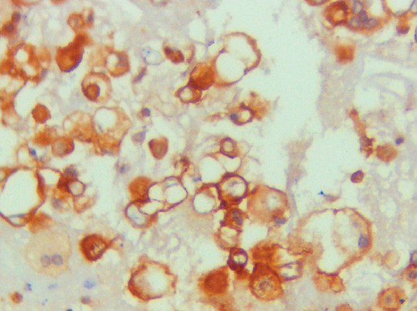 Role of HEG1 and Claudin-4 Immunohistochemistry in the Differential Diagnosis of Lung Adenocarcinoma from Malignant Mesothelioma in Pleural Effusion Cytology.