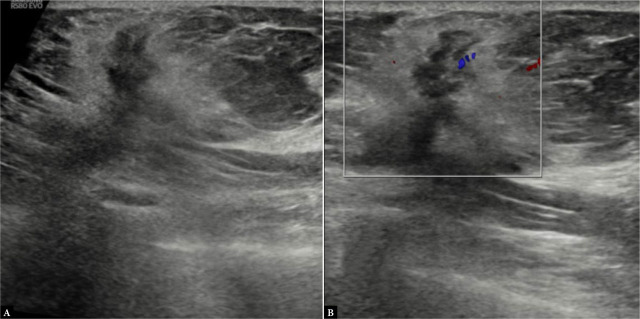 Ultrasonography: an aid in molecular subtyping of breast carcinoma.