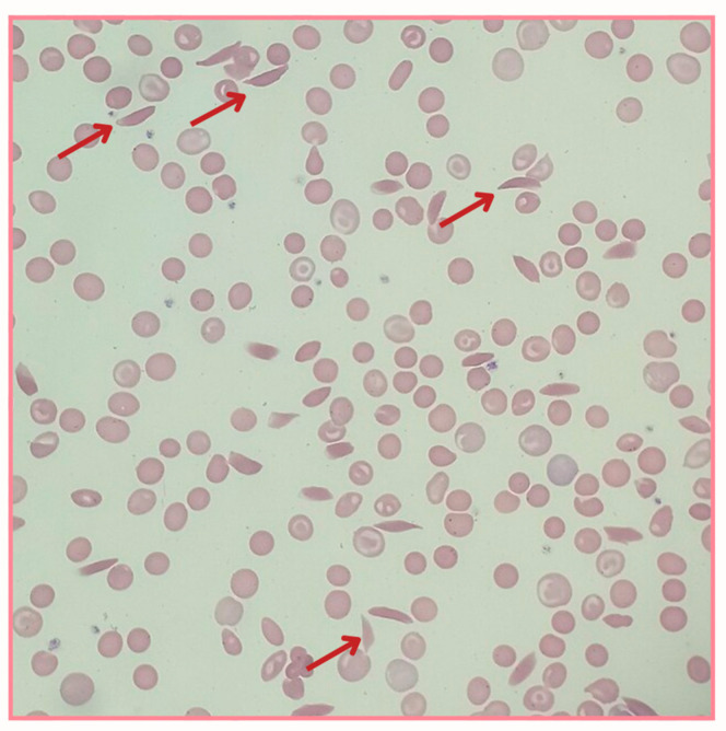 Sickle Cell Anemia and Inflammation: A Review of Stones and Landmarks Paving the Road in the Last 25 Years.