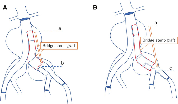 Endovascular Repair of Iliac Aneurysms Using the Gore Iliac Branch Endoprosthesis with Up-and-Over Technique.