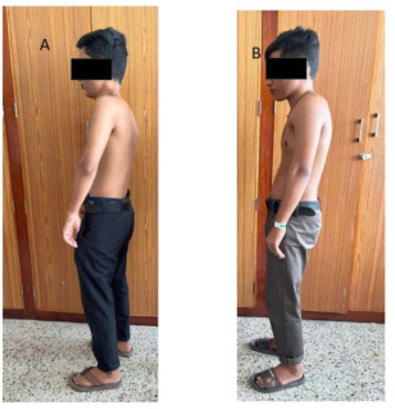 All Restricted Spines are not Spondyloarthritis: Fibrodysplasia Ossificans Progressiva (FOP) in Monozygotic Twins presenting to Rheumatology Clinic.